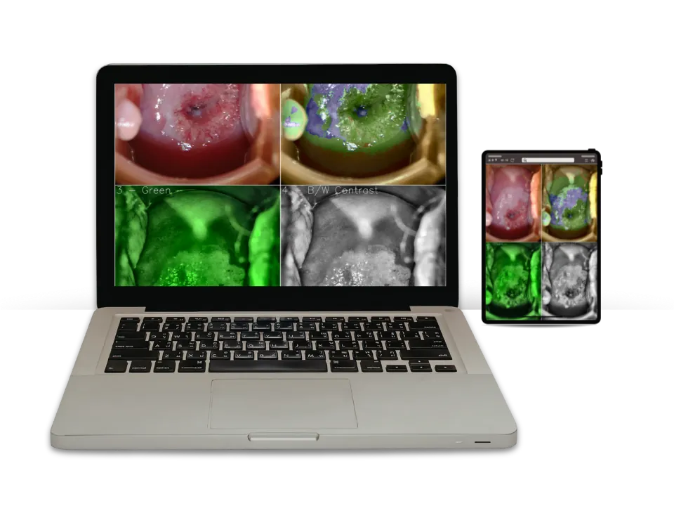 Griva Vision diagnostic software interface demonstrating optional AI-assisted screening heatmap lesion analysis